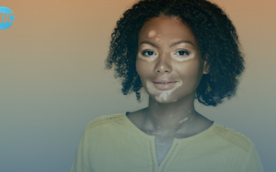 Entendendo o Vitiligo: Desvendando os Mistérios da Perda de Pigmentação