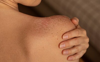 Mitos e Verdades sobre Fototerapia: Esclareça Dúvidas Comuns 