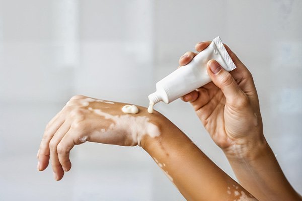 Melhor tratamento para vitiligo 2026