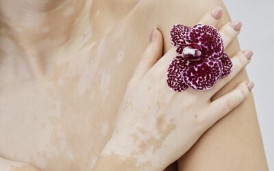Repigmentação no Vitiligo: Entenda o processo do tratamento