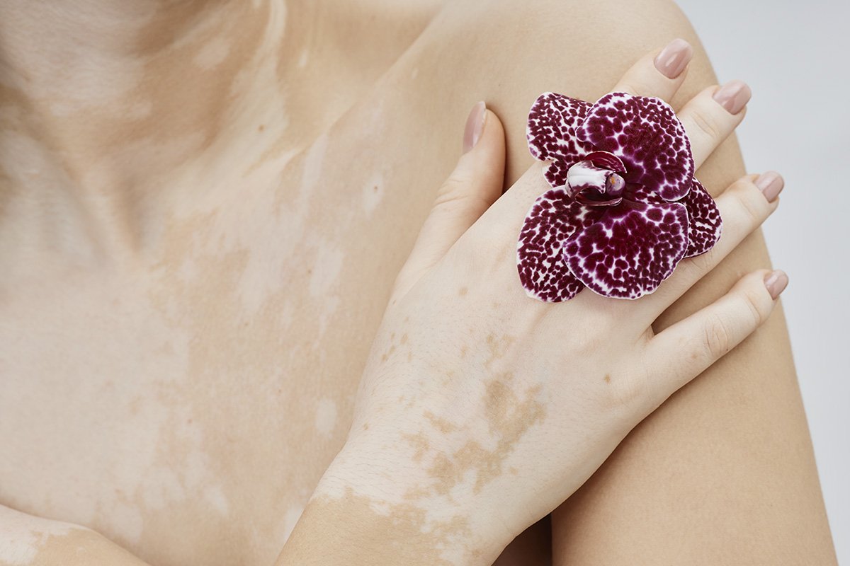 Repigmentação no Vitiligo: Entenda o processo do tratamento