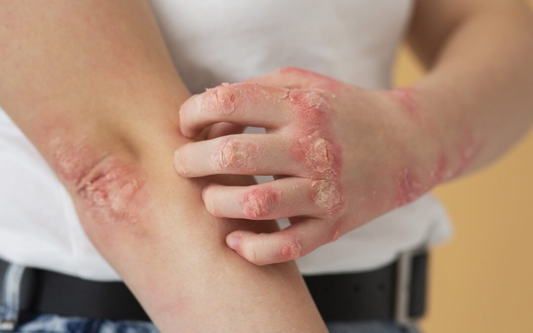Fototerapia para Dermatite Atópica: Como o Tratamento Alivia a Coceira e as Lesões