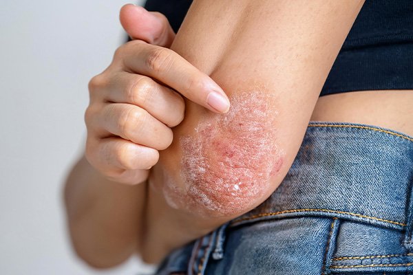 Melhor tratamento para vitiligo 2026