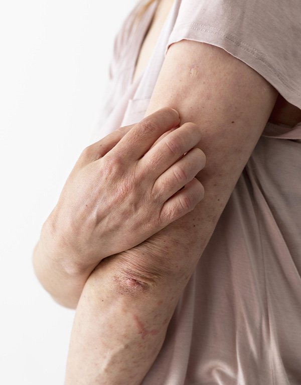 dermatite atopica tratamento Melhor tratamento para vitiligo 2026