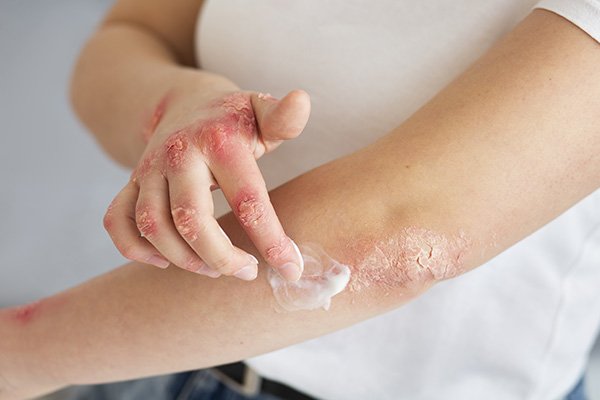 tratamento eficaz para psoriase em sp