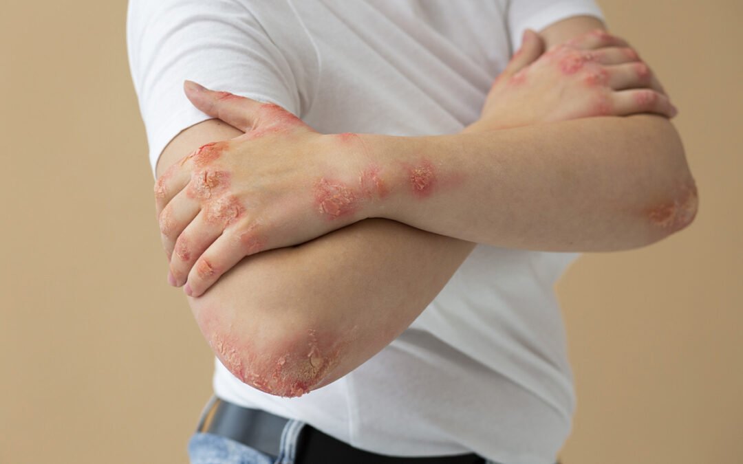 Fototerapia para Psoríase: Como o tratamento reduz as placas e inflamações